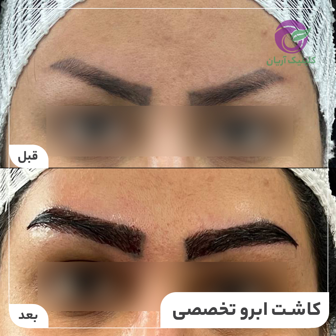 گالری فیلم کاشت ابرو